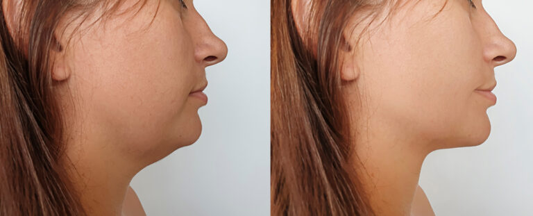 Before and after facelift female patient right side view