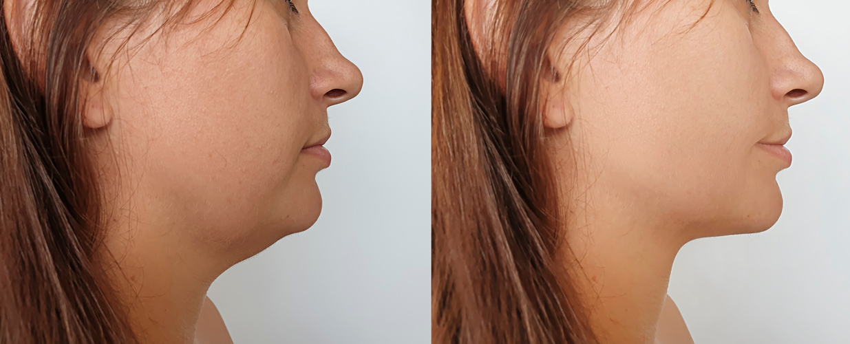 Before and after facelift female patient right side view